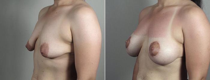 Breast Lift with Implants Case 493 Before & After View #2 | Paramus, New Jersey | Parker Center for Plastic Surgery