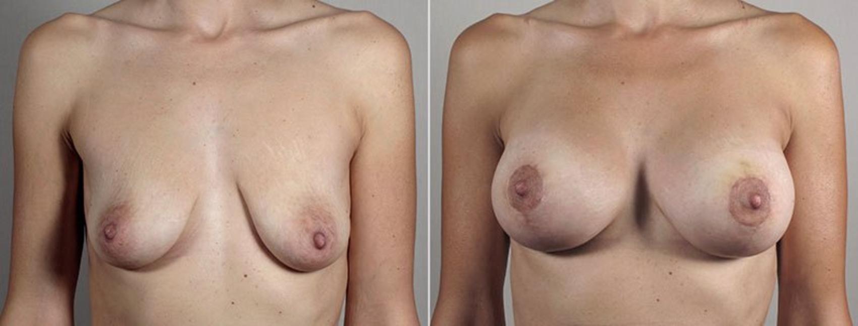 Breast Lift with Implants Case 494 Before & After View #1 | Paramus, New Jersey | Parker Center for Plastic Surgery