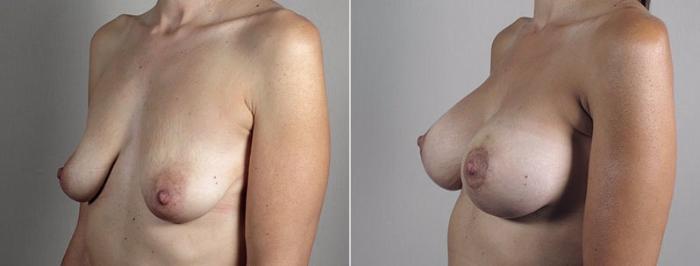 Breast Lift with Implants Case 494 Before & After View #2 | Paramus, New Jersey | Parker Center for Plastic Surgery