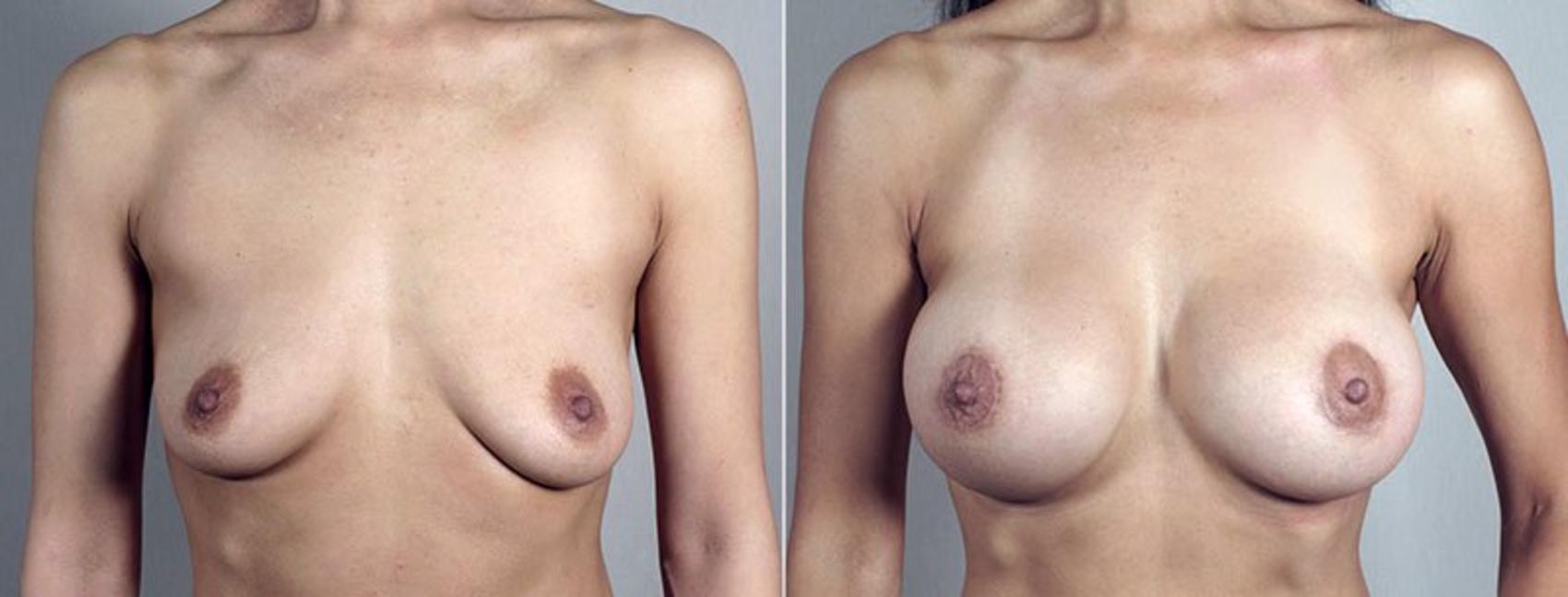 Breast Lift with Implants Case 495 Before & After View #1 | Paramus, New Jersey | Parker Center for Plastic Surgery