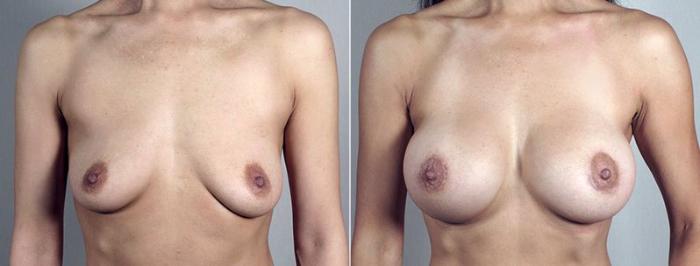 Breast Lift with Implants Case 495 Before & After View #1 | Paramus, New Jersey | Parker Center for Plastic Surgery