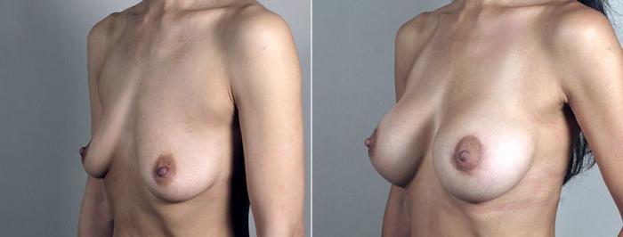 Breast Lift with Implants Case 495 Before & After View #2 | Paramus, New Jersey | Parker Center for Plastic Surgery