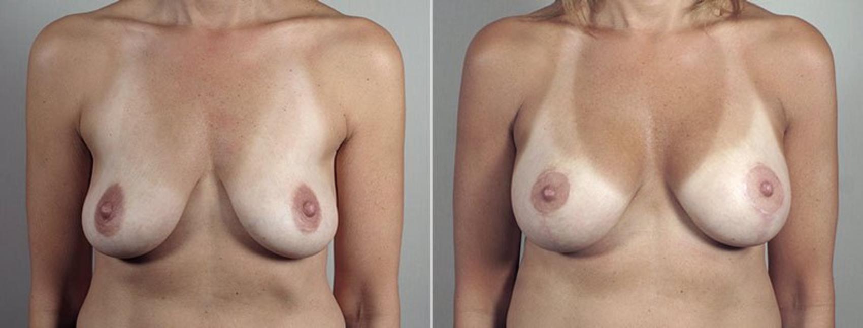 Breast Lift with Implants Case 497 Before & After View #1 | Paramus, New Jersey | Parker Center for Plastic Surgery