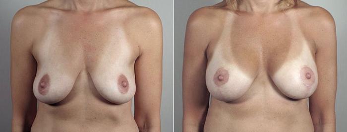 Breast Lift with Implants Case 497 Before & After View #1 | Paramus, New Jersey | Parker Center for Plastic Surgery