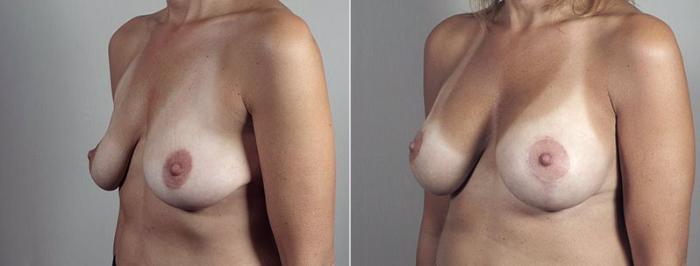 Breast Lift with Implants Case 497 Before & After View #2 | Paramus, New Jersey | Parker Center for Plastic Surgery