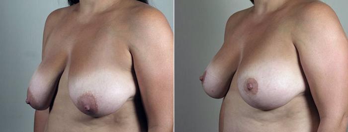 Breast Lift with Implants Case 498 Before & After View #2 | Paramus, New Jersey | Parker Center for Plastic Surgery