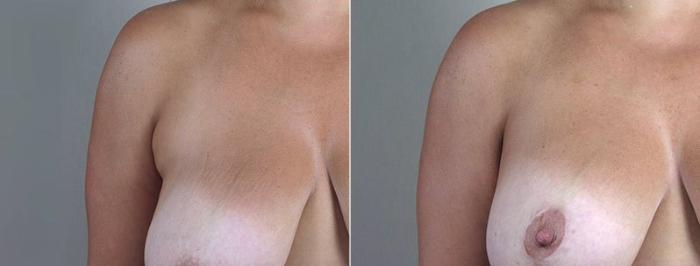 Breast Lift with Implants Case 498 Before & After View #3 | Paramus, New Jersey | Parker Center for Plastic Surgery