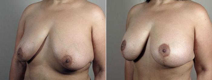 Breast Lift with Implants Case 499 Before & After View #1 | Paramus, New Jersey | Parker Center for Plastic Surgery