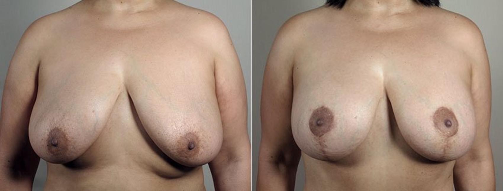 Breast Lift with Implants Case 499 Before & After View #2 | Paramus, New Jersey | Parker Center for Plastic Surgery