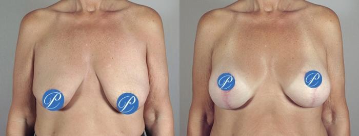 Breast Lift with Implants Case 898 Before & After View #4 | Paramus, New Jersey | Parker Center for Plastic Surgery
