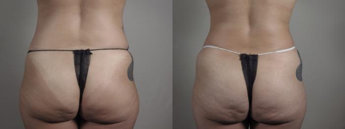 Breast Lift with Implants Case 975 Before & After Back | Paramus, New Jersey | Parker Center for Plastic Surgery