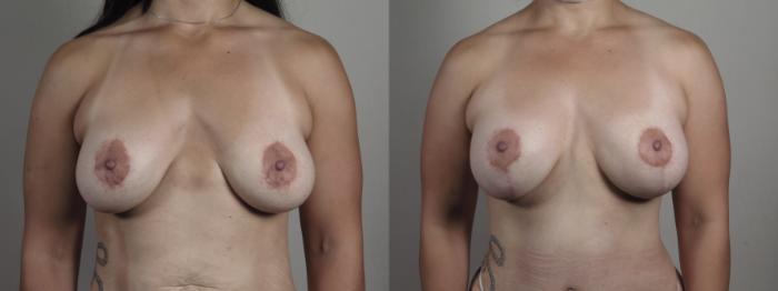 Breast Lift with Implants Case 975 Before & After front b view | Paramus, New Jersey | Parker Center for Plastic Surgery