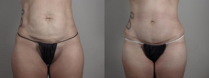 Breast Lift with Implants Case 975 Before & After Front | Paramus, New Jersey | Parker Center for Plastic Surgery