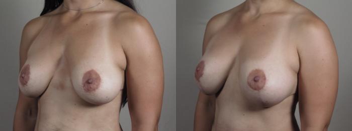 Breast Lift with Implants Case 975 Before & After right 3/4 b view 2 | Paramus, New Jersey | Parker Center for Plastic Surgery