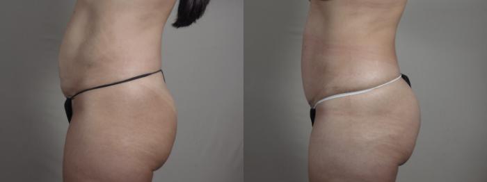 Breast Lift with Implants Case 975 Before & After Right Side | Paramus, New Jersey | Parker Center for Plastic Surgery
