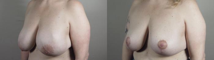 Breast Lift with Implants Case 982 Before & After Right Oblique | Paramus, New Jersey | Parker Center for Plastic Surgery