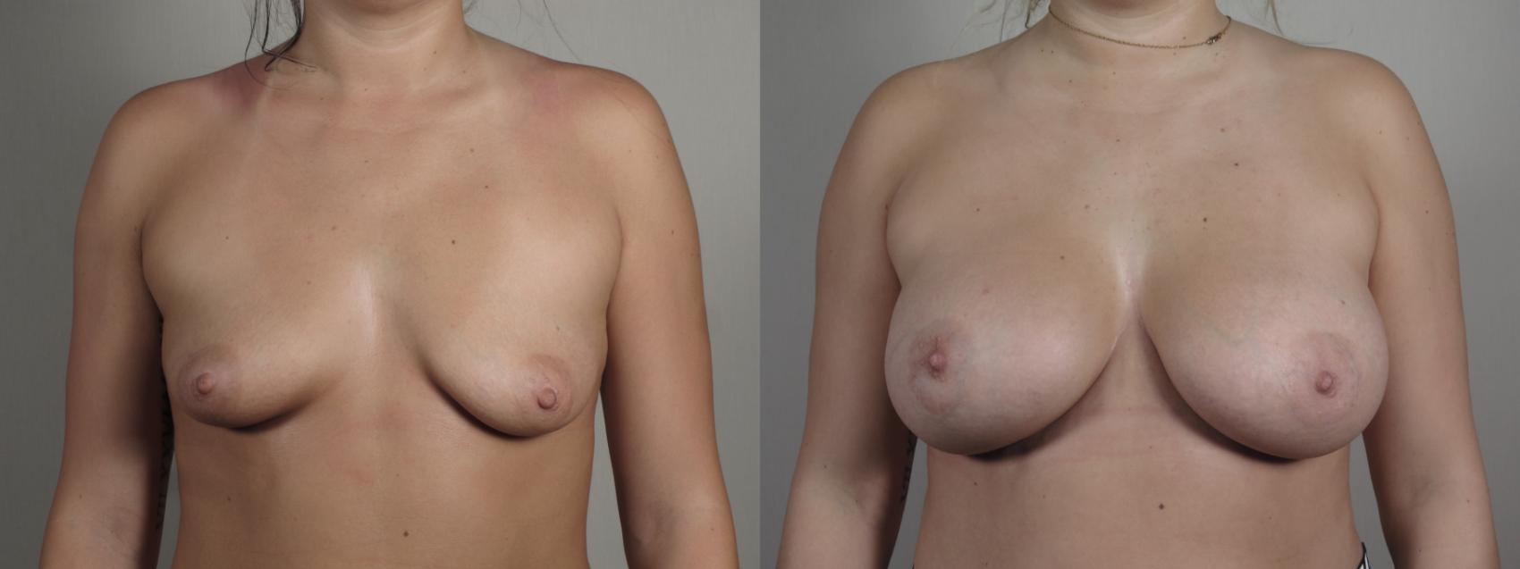 Breast Lift with Implants Case 993 Before & After Front | Paramus, New Jersey | Parker Center for Plastic Surgery