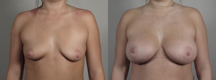 Breast Lift with Implants Case 993 Before & After Front | Paramus, New Jersey | Parker Center for Plastic Surgery