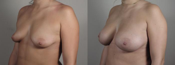 Breast Lift with Implants Case 993 Before & After Right Oblique | Paramus, New Jersey | Parker Center for Plastic Surgery