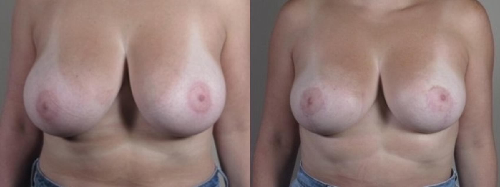 Breast Reduction Case 1252 Before & After Front | Paramus, New Jersey | Parker Center for Plastic Surgery