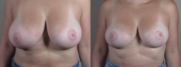 Breast Reduction Case 1252 Before & After Front | Paramus, New Jersey | Parker Center for Plastic Surgery