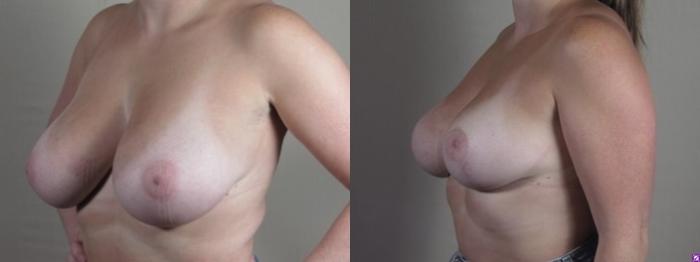 Breast Reduction Case 1252 Before & After Left Oblique | Paramus, New Jersey | Parker Center for Plastic Surgery