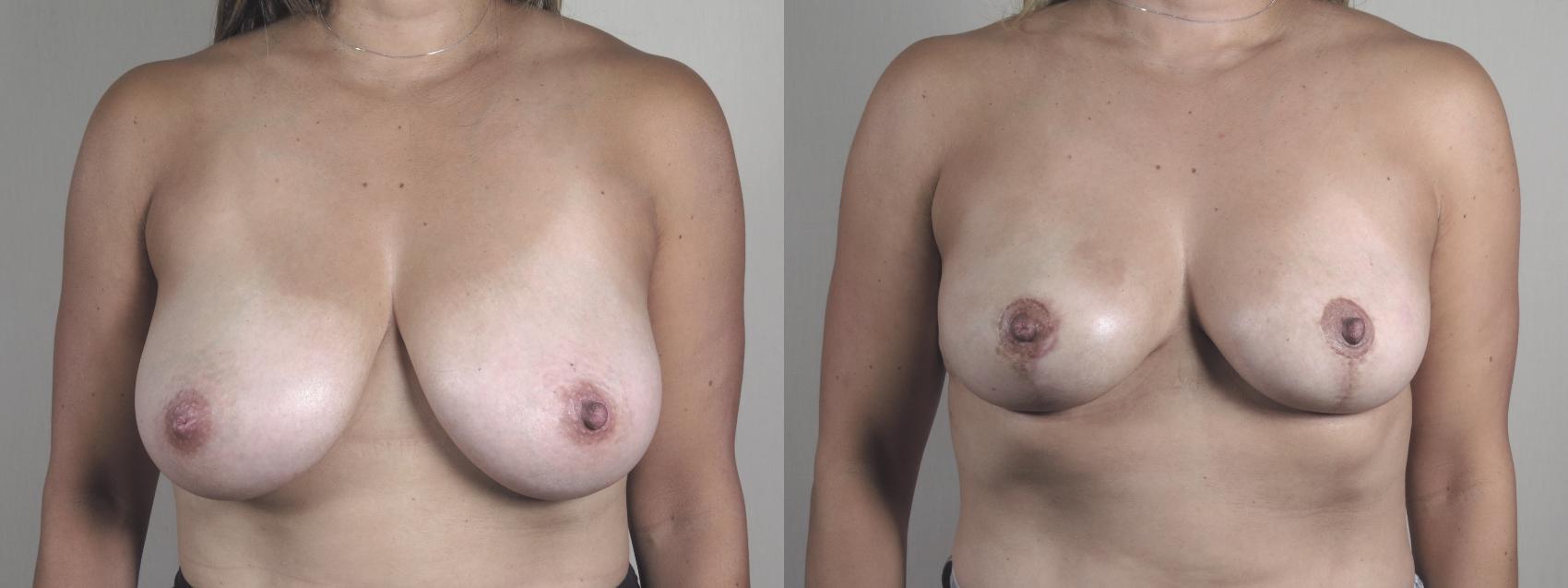 Breast Reduction Case 1328 Before & After Front | Paramus, New Jersey | Parker Center for Plastic Surgery