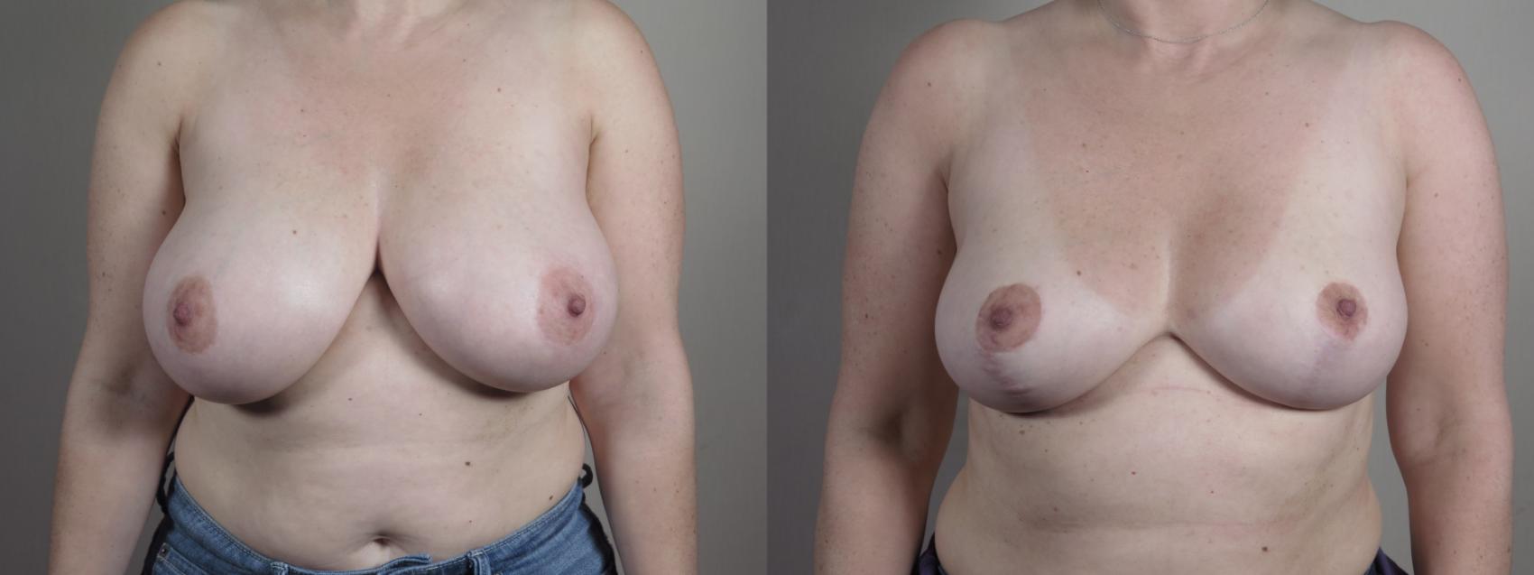 Breast Reduction Case 1329 Before & After Front | Paramus, New Jersey | Parker Center for Plastic Surgery