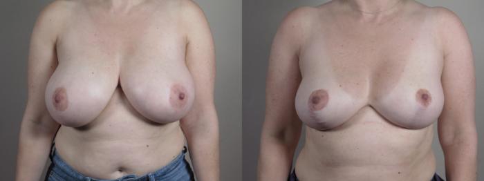 Breast Reduction Case 1329 Before & After Front | Paramus, New Jersey | Parker Center for Plastic Surgery