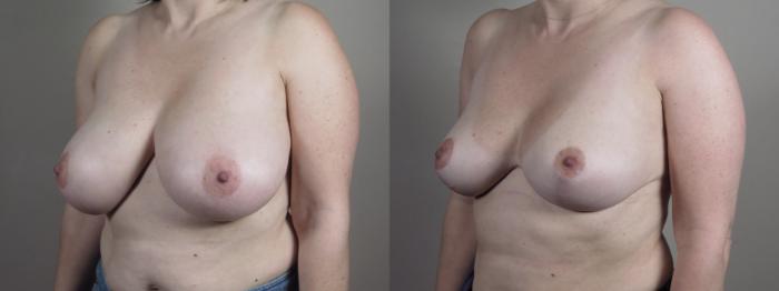 Breast Reduction Case 1329 Before & After Left Oblique | Paramus, New Jersey | Parker Center for Plastic Surgery