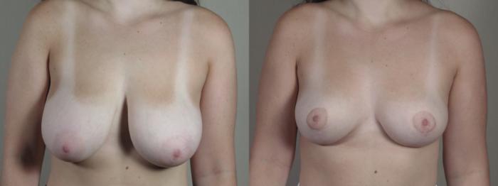 Breast Reduction Case 1331 Before & After Front | Paramus, New Jersey | Parker Center for Plastic Surgery