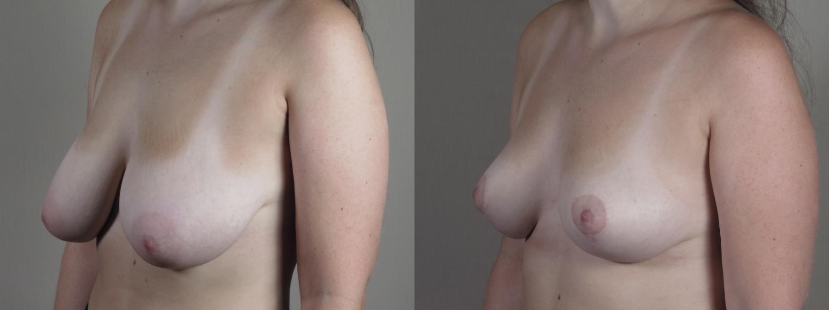 Breast Reduction Case 1331 Before & After Left Oblique | Paramus, New Jersey | Parker Center for Plastic Surgery