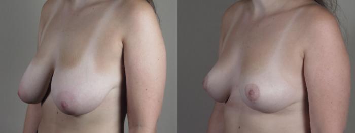 Breast Reduction Case 1331 Before & After Left Oblique | Paramus, New Jersey | Parker Center for Plastic Surgery