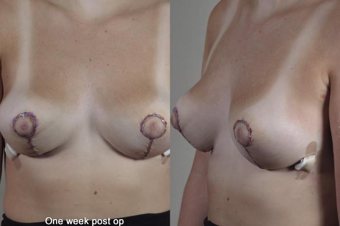 Breast Reduction Case 1361 Before & After 1 week  | Paramus, New Jersey | Parker Center for Plastic Surgery