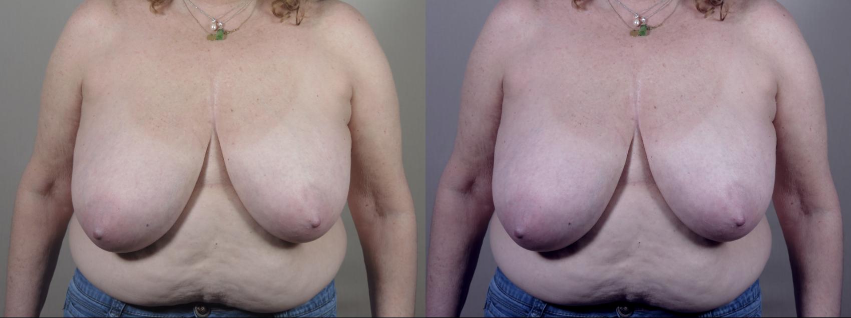 Breast Reduction Case 1572 Before & After Front | Paramus, New Jersey | Parker Center for Plastic Surgery