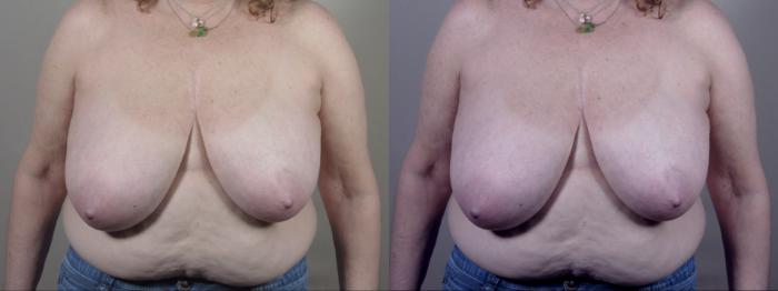 Breast Reduction Case 1572 Before & After Front | Paramus, New Jersey | Parker Center for Plastic Surgery