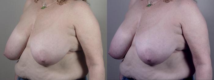 Breast Reduction Case 1572 Before & After Left Oblique | Paramus, New Jersey | Parker Center for Plastic Surgery