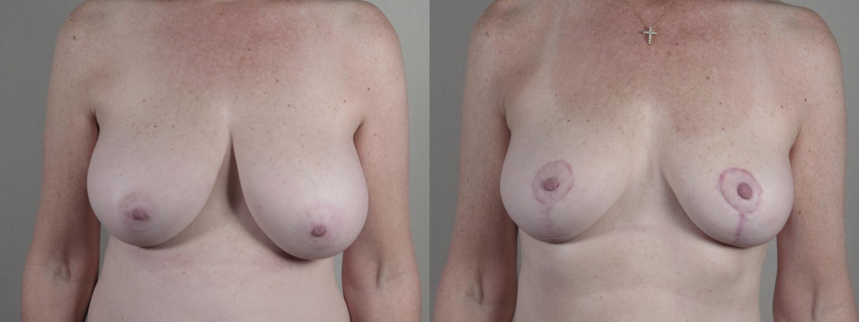 Breast Reduction Case 1642 Before & After Front | Paramus, New Jersey | Parker Center for Plastic Surgery