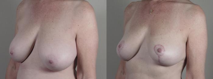 Breast Reduction Case 1642 Before & After Left Oblique | Paramus, New Jersey | Parker Center for Plastic Surgery