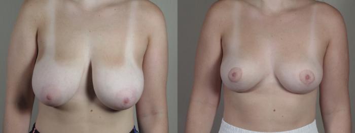 Breast Reduction Case 1676 Before & After Front | Paramus, New Jersey | Parker Center for Plastic Surgery