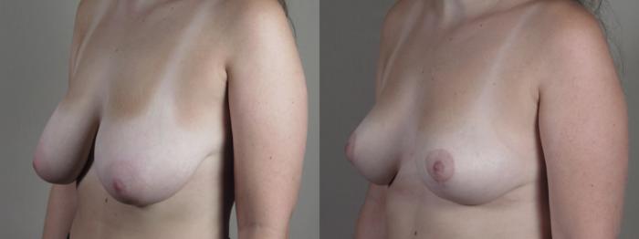 Breast Reduction Case 1676 Before & After Left Oblique | Paramus, New Jersey | Parker Center for Plastic Surgery