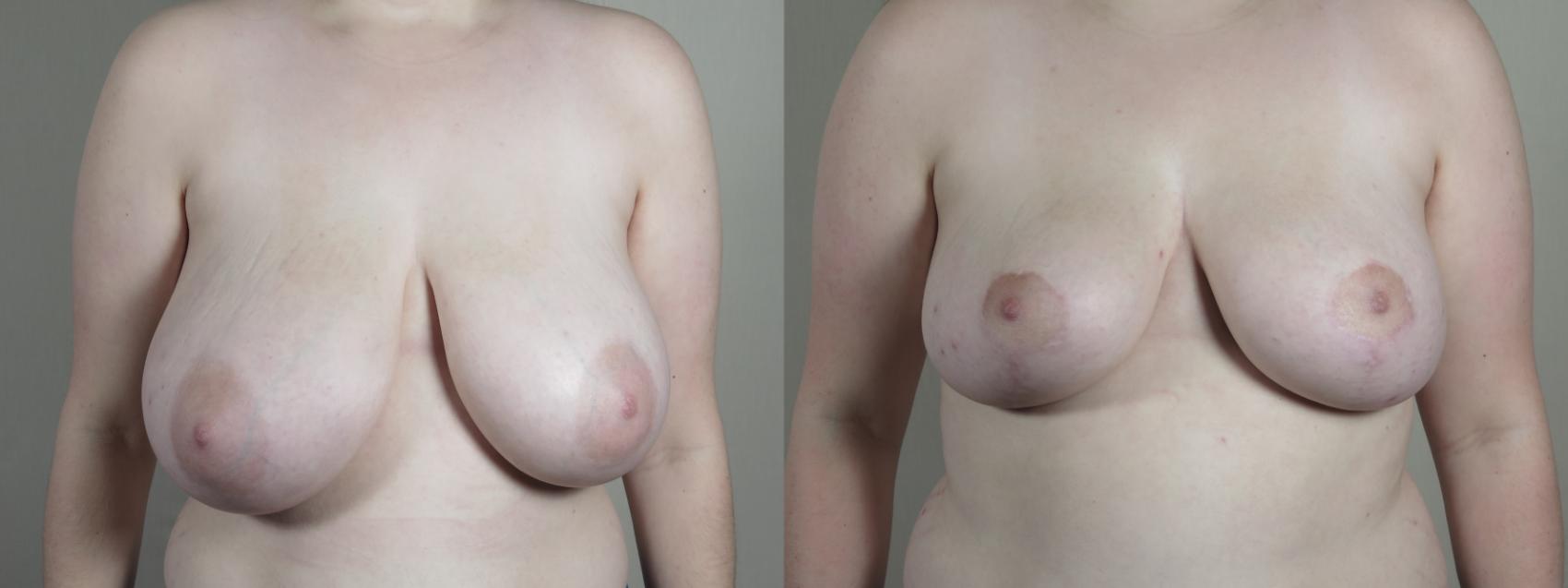 Breast Reduction Case 1677 Before & After Front | Paramus, New Jersey | Parker Center for Plastic Surgery