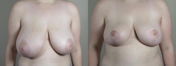 Breast Reduction Case 1677 Before & After Front | Paramus, New Jersey | Parker Center for Plastic Surgery