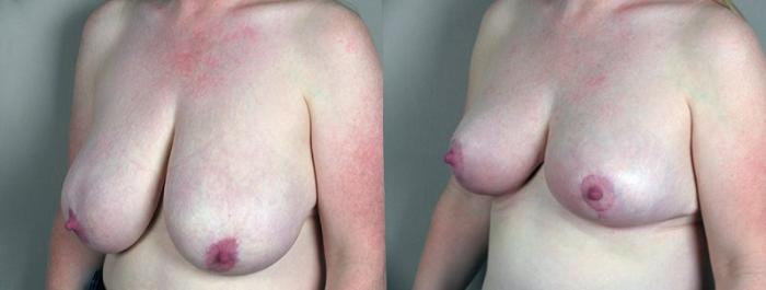 Breast Reduction Case 523 Before & After View #2 | Paramus, New Jersey | Parker Center for Plastic Surgery