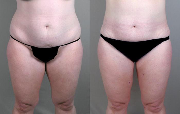 Breast Reduction Case 523 Before & After View #3 | Paramus, New Jersey | Parker Center for Plastic Surgery