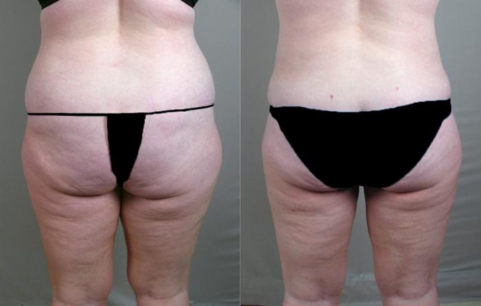 Breast Reduction Case 523 Before & After View #4 | Paramus, New Jersey | Parker Center for Plastic Surgery