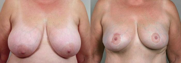 Breast Lift Case 524 Before & After View #1 | Paramus, New Jersey | Parker Center for Plastic Surgery
