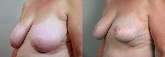 Breast Lift Case 524 Before & After View #2 | Paramus, New Jersey | Parker Center for Plastic Surgery