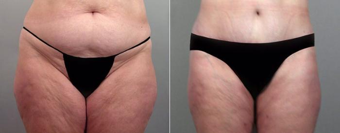 Breast Lift Case 524 Before & After View #3 | Paramus, New Jersey | Parker Center for Plastic Surgery