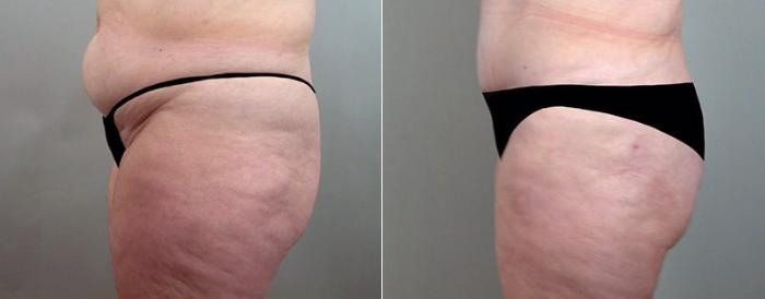 Breast Lift Case 524 Before & After View #4 | Paramus, New Jersey | Parker Center for Plastic Surgery